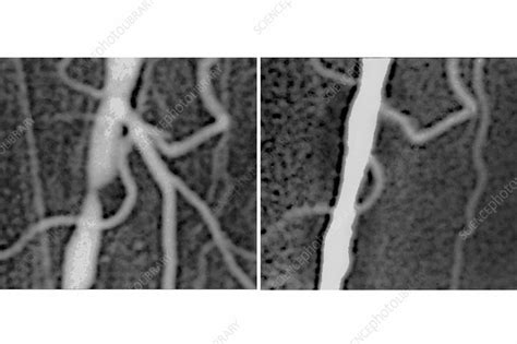 angion method before and after.
